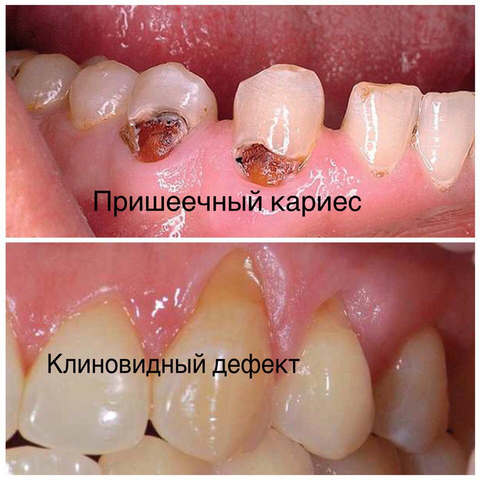 Кариозные и некариозные поражения зубов